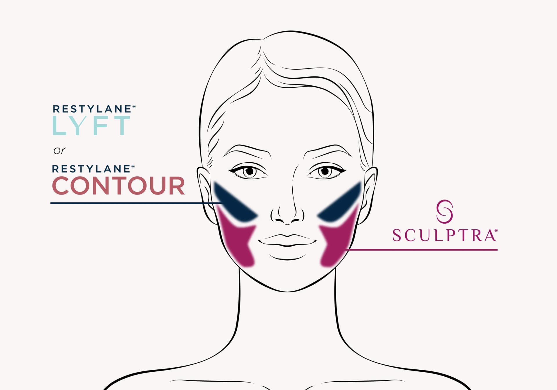 Diagram of facial treatment target areas for Sculptra and dermal fillers
