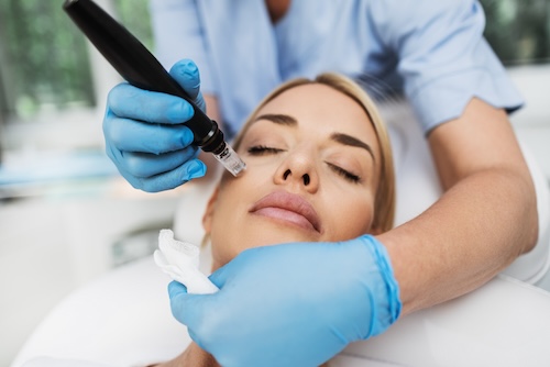 Scarlet RF microneedling treatment being performed on a patient